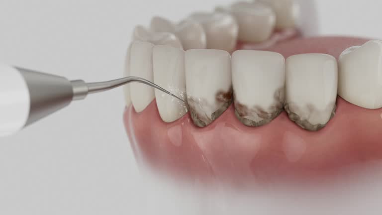 Trusted Wisdom Tooth Removal service in Raceland, KY - Dentist Open Now